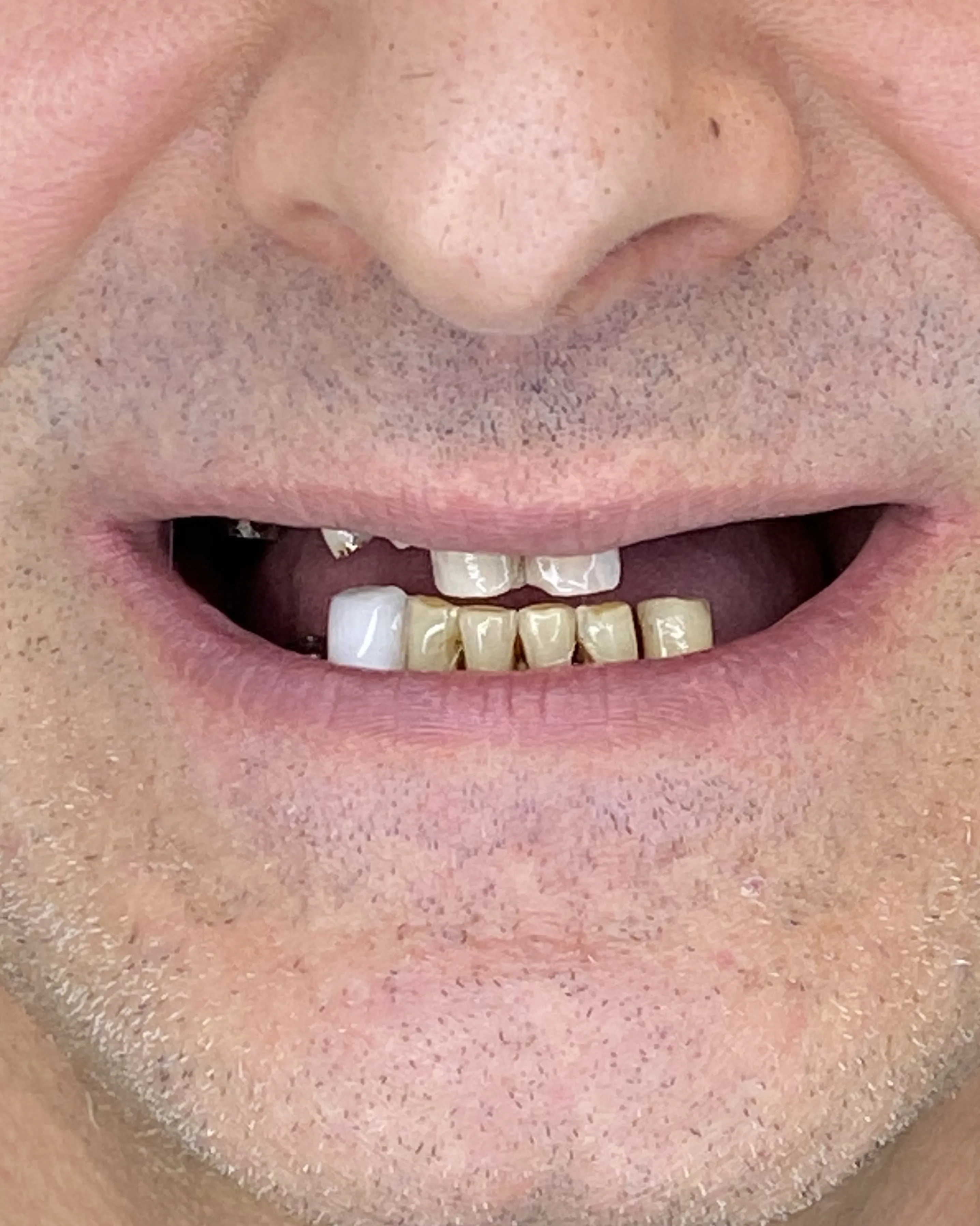 Dental Implants & Porcelain Veneers treatment 2