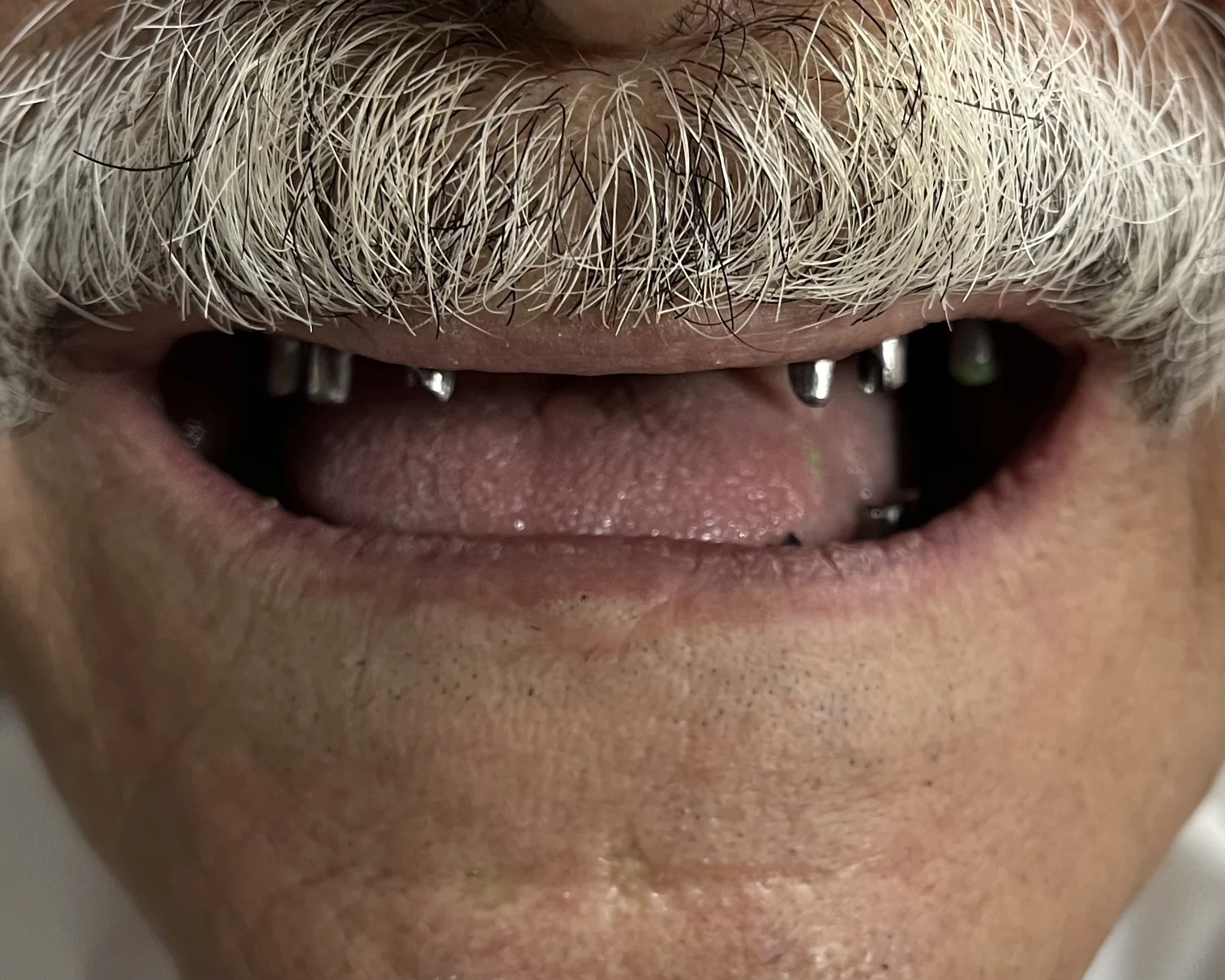 Full mouth dental implants treatment 1