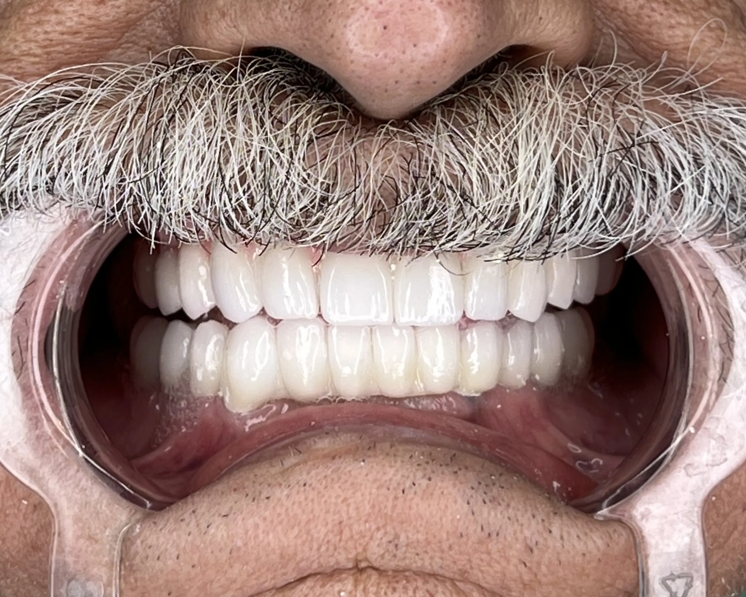 Full mouth dental implants treatment 2